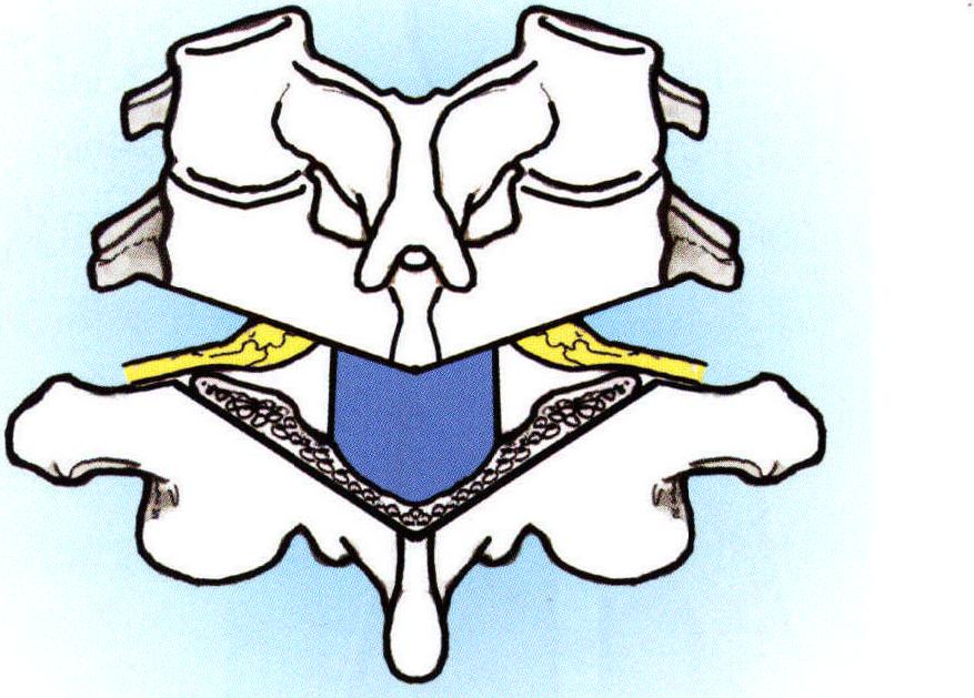 四、单纯椎板间截骨的手术方法